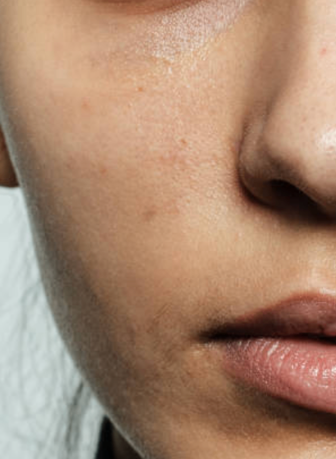 Skin_before_treatment.png