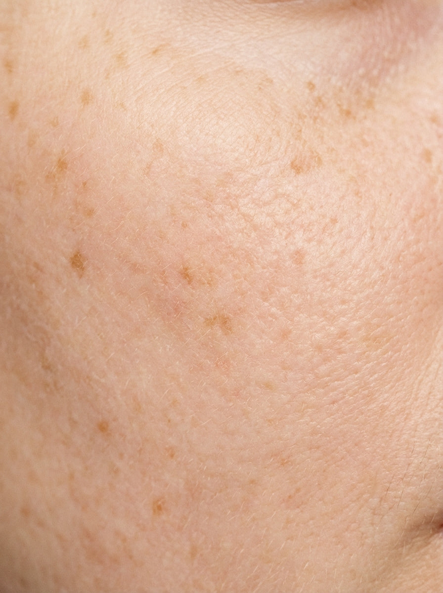 Pigmentation