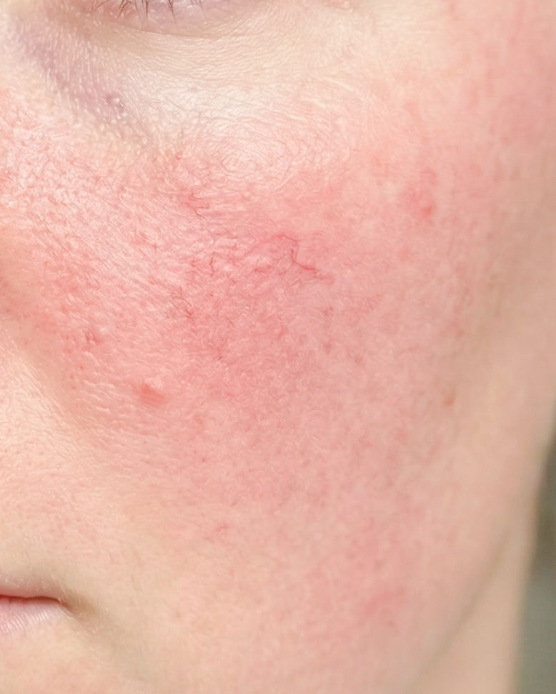 Rosacea